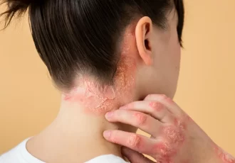 psoriasis-eczema-neck-patient (1)